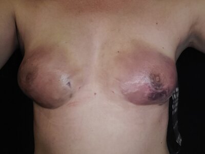 24 uur Na lipofilling gespiegeld