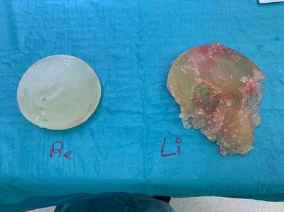 kapotte prothese Allergan