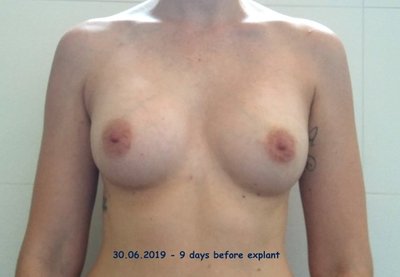 IMG_20190630_135902sm (Small).jpg (46.69 KiB) 15682 keer bekeken 9 dagen voor explantatie