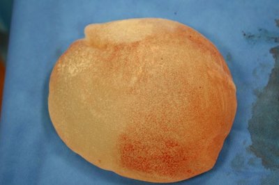 Franken 210861 implantaat+kapsel (12).JPG