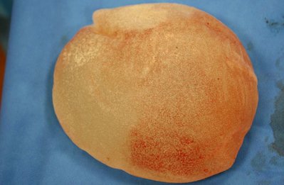 Franken 210861 implantaat+kapsel (13).JPG